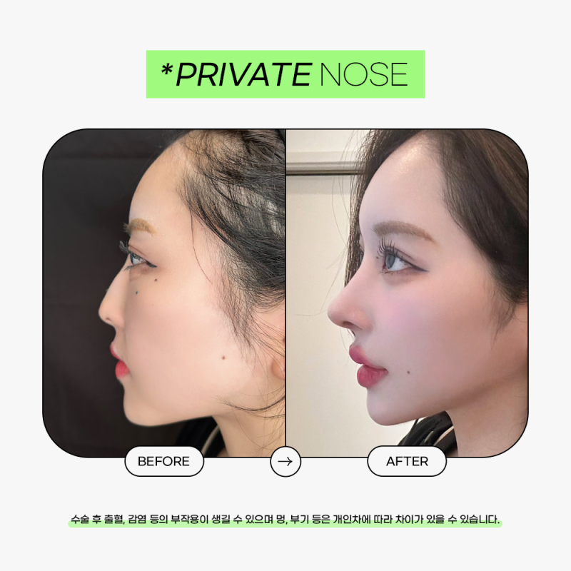 성형모델리얼모델 상시모집 프라이빗성형외과 사진 8