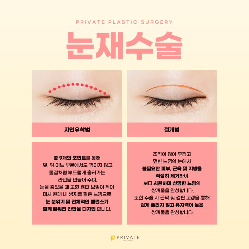 눈재수술성형후기는 프라이빗성형외과 사진 4