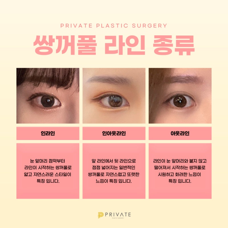 눈재수술성형후기는 프라이빗성형외과 사진 5