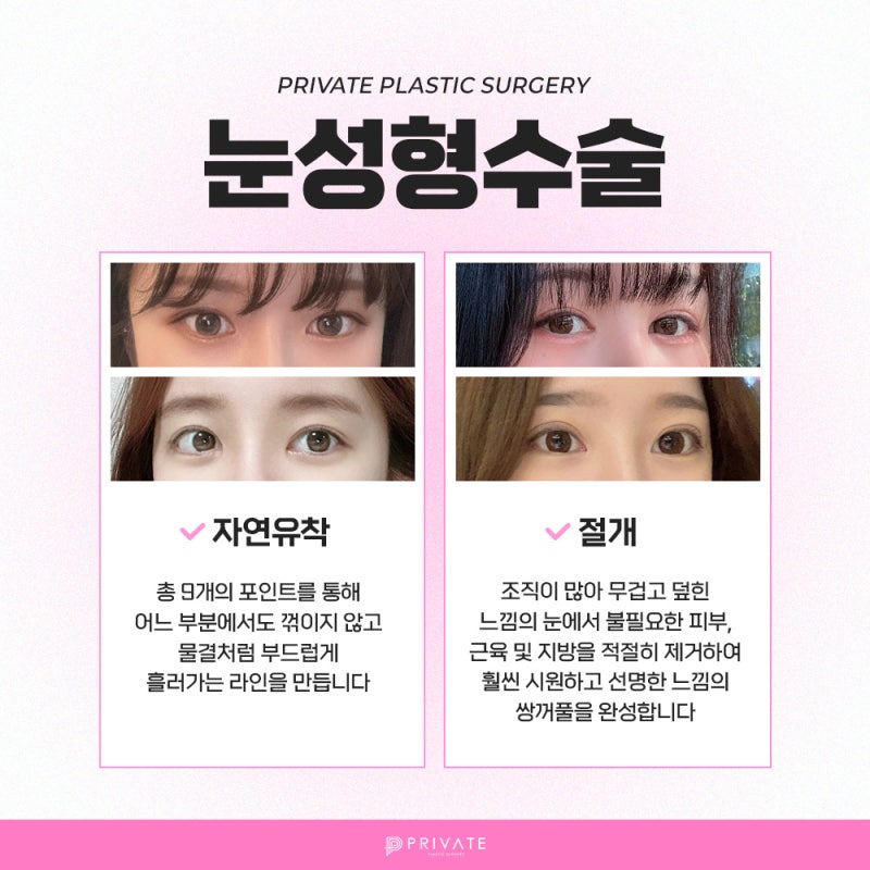 쌍수 예쁘게 잘하는 곳 프라이빗성형외과 사진 4