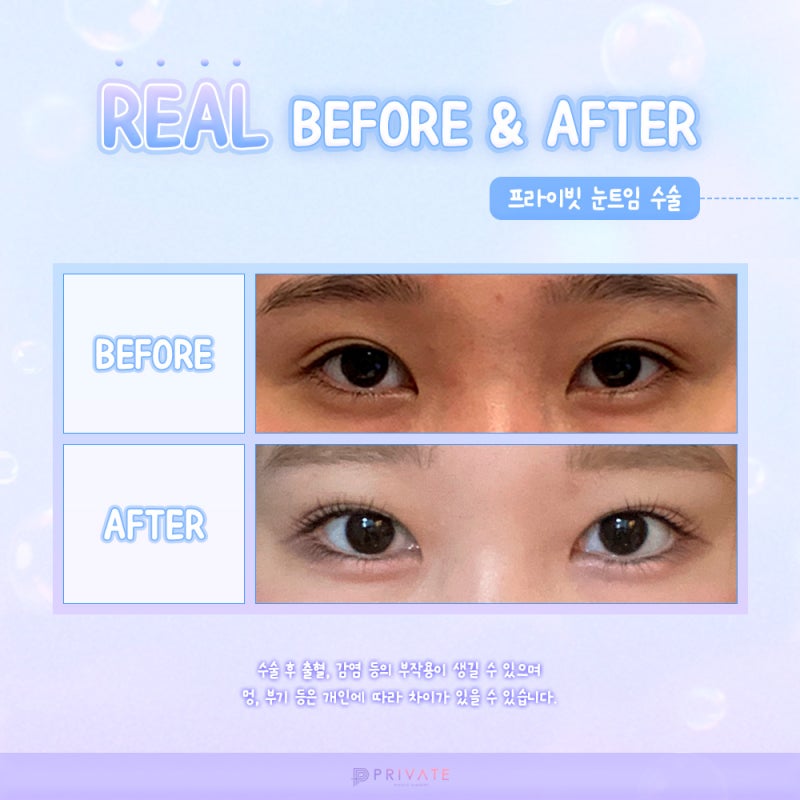 눈트임수술 깔끔하게 잘하는곳 프라이빗성형외과 사진 5