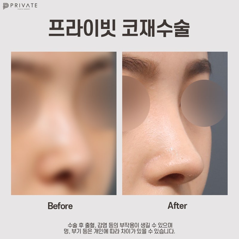 자가늑 코재수술 후기 많은곳 프라이빗성형외과 사진 7