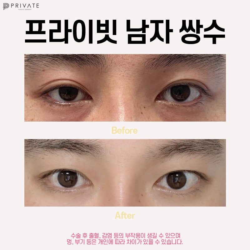 프라이빗성형외과 남자눈성형, 첫인상을 바꾸는 또 하나의 선택 사진 5