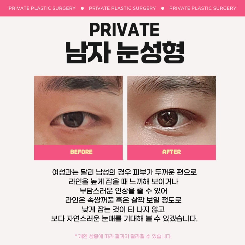 프라이빗성형외과 남자눈성형, 첫인상을 바꾸는 또 하나의 선택