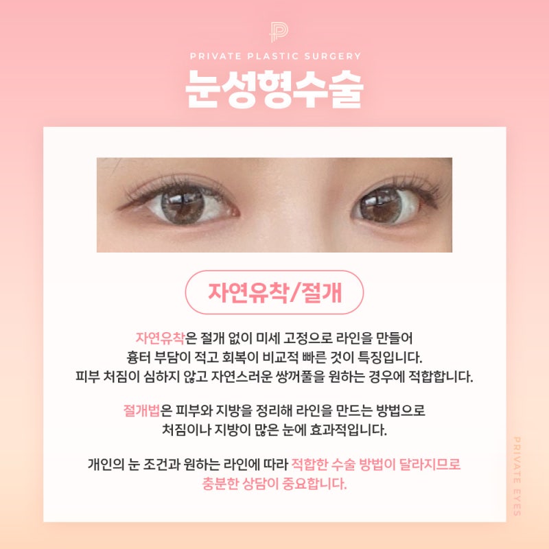 눈성형수술 잘하는곳 찾는다면 프라이빗성형외과에서 맞춤 눈성형 사진 4