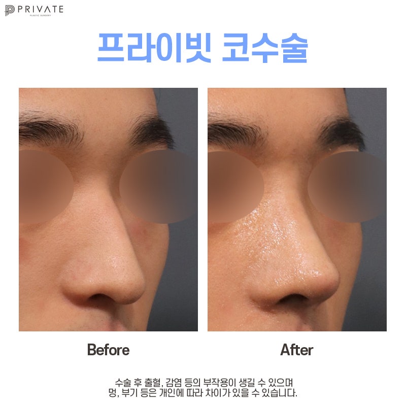 신사 프라이빗성형외과 남자코성형유명한곳 사진 5