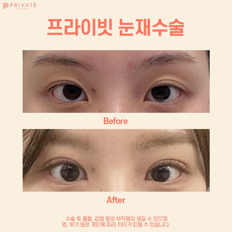 신사 눈재수술잘하는곳 프라이빗성형외과 사진 8