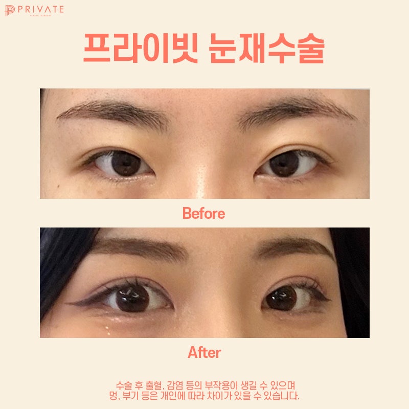 신사 눈재수술잘하는곳 프라이빗성형외과 사진 7