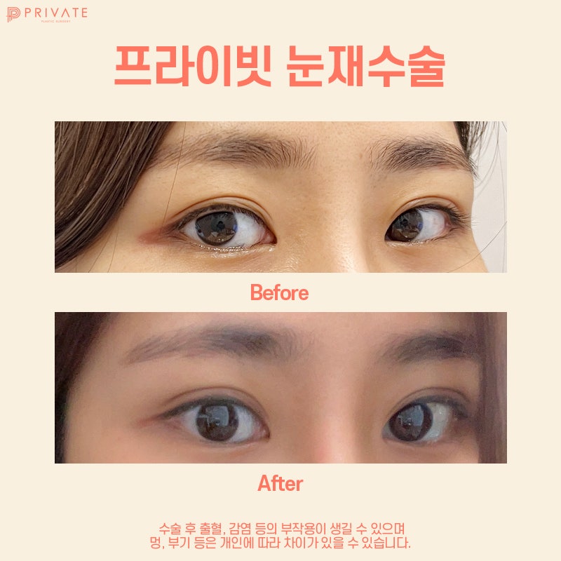 신사 눈재수술잘하는곳 프라이빗성형외과 사진 9