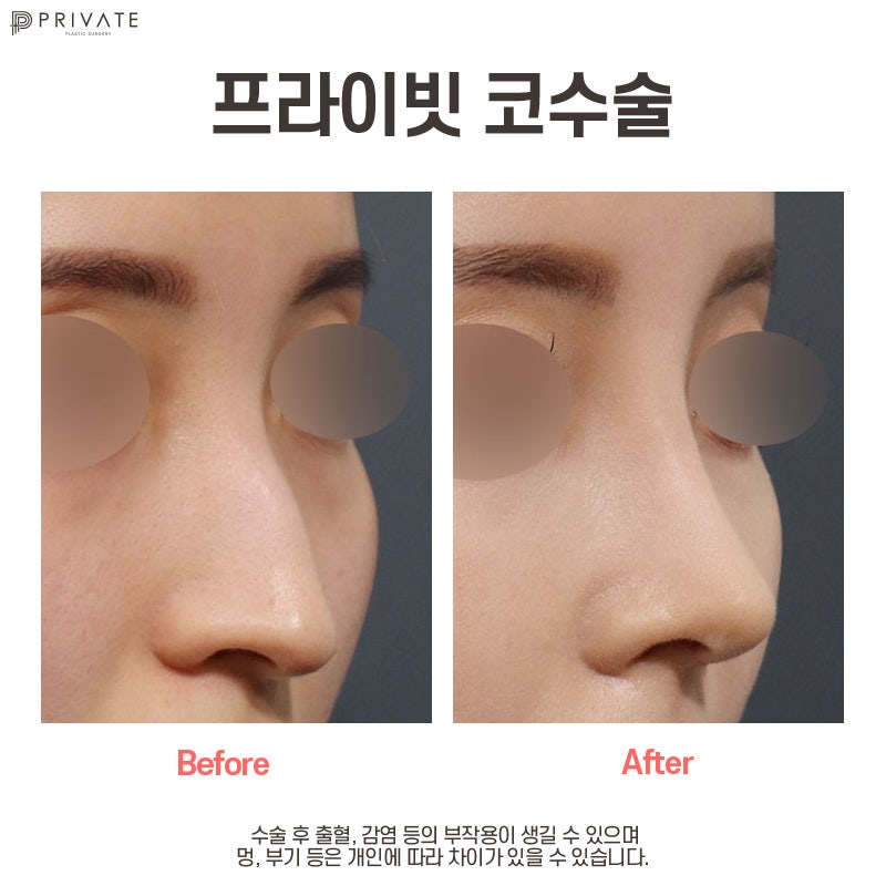 프라이빗성형외과 매부리코수술 교정으로 달라보이는 마법 사진 9