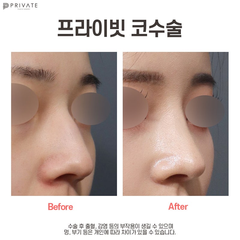 프라이빗성형외과 매부리코수술 교정으로 달라보이는 마법 사진 8