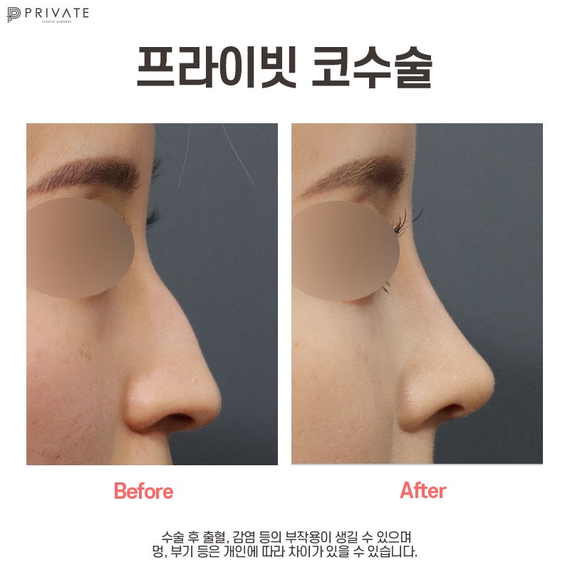프라이빗성형외과 매부리코수술 교정으로 달라보이는 마법 사진 7