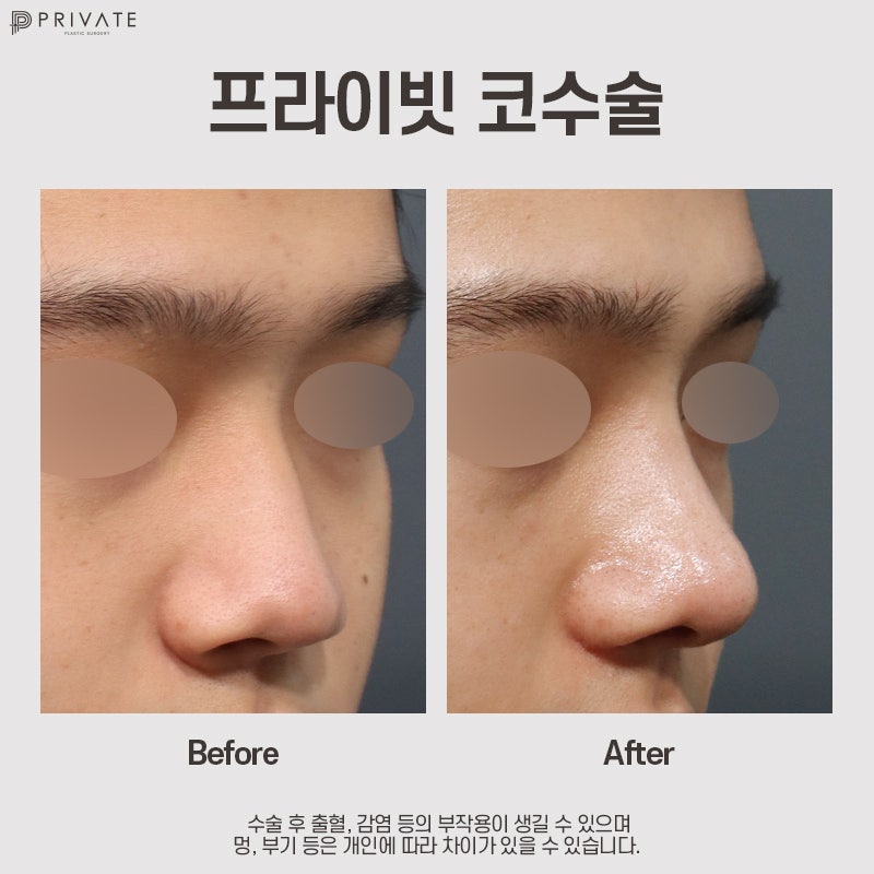 Private Plastic Surgery, Hasil Operasi Hidung Pria yang Bagus 사진 10