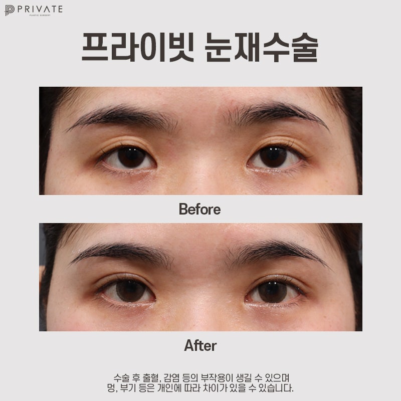 눈재수술잘하는곳 신사 프라이빗성형외과 사진 8