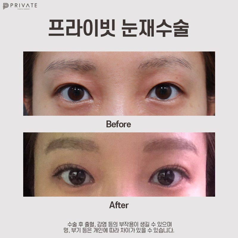 눈재수술잘하는곳 신사 프라이빗성형외과 사진 9