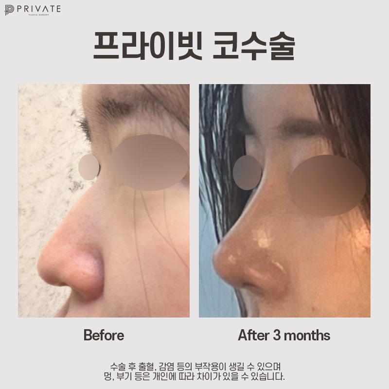 자가늑 코수술 고민이라면, 프라이빗성형외과 사진 13