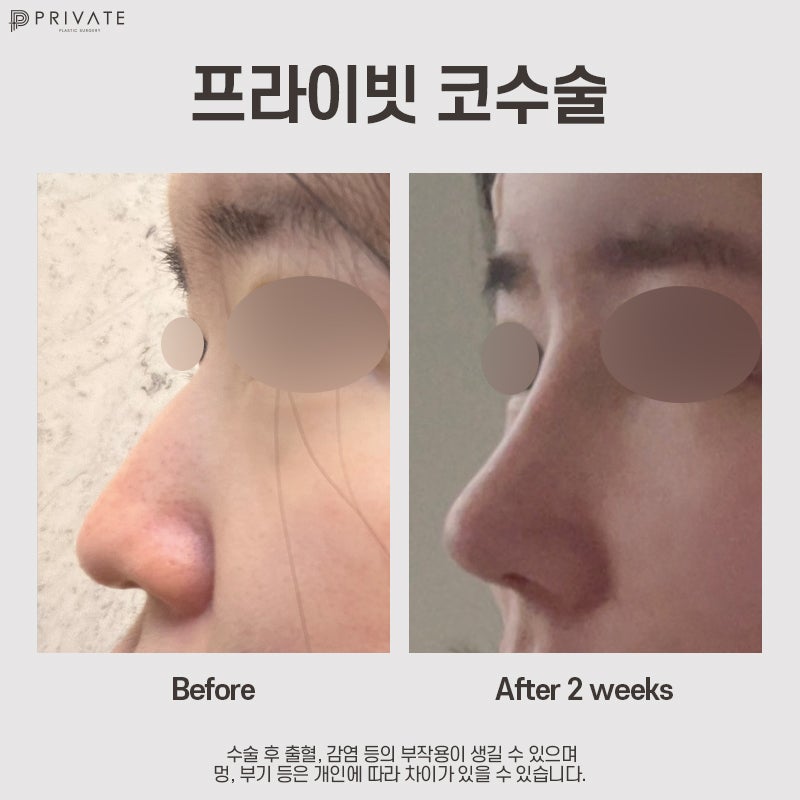 자가늑 코수술 고민이라면, 프라이빗성형외과 사진 10