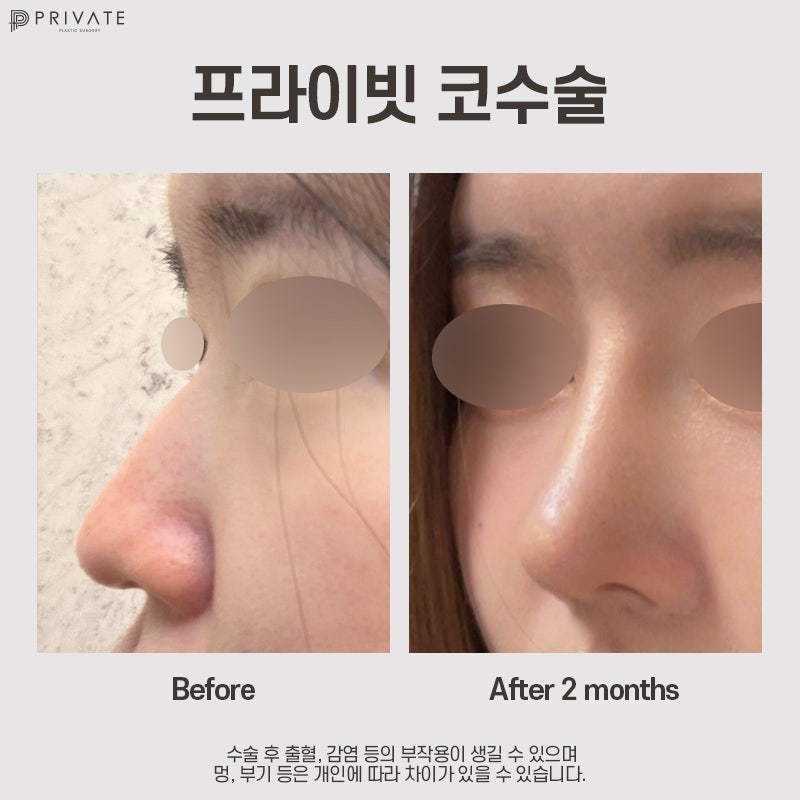 자가늑 코수술 고민이라면, 프라이빗성형외과 사진 11