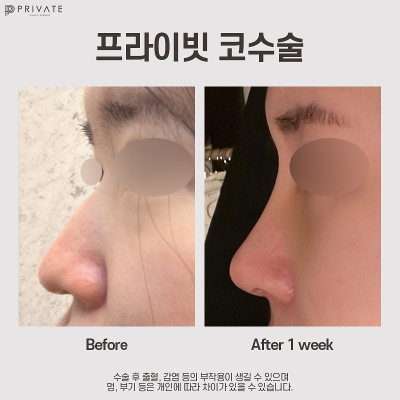 자가늑 코수술 고민이라면, 프라이빗성형외과 사진 9