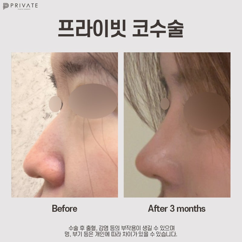 자가늑 코수술 고민이라면, 프라이빗성형외과 사진 12