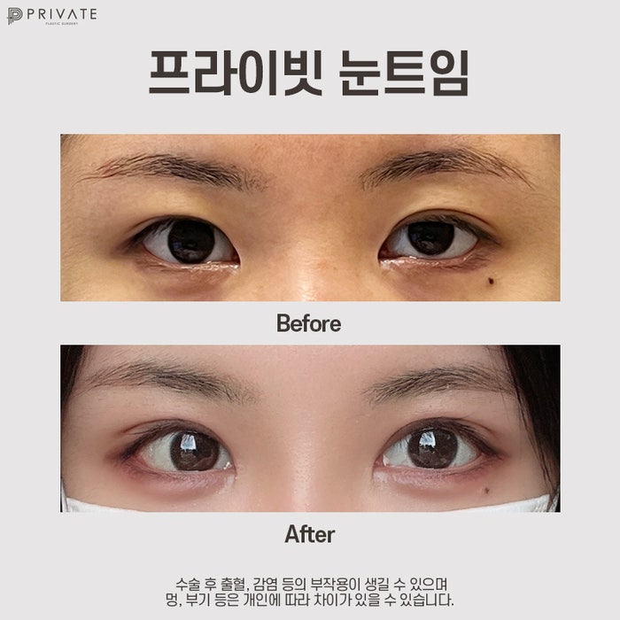 눈트임잘하는곳 신사 프라이빗성형외과 사진 9