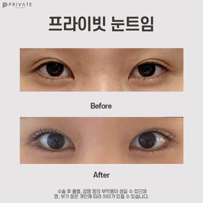 눈트임잘하는곳 신사 프라이빗성형외과 사진 10
