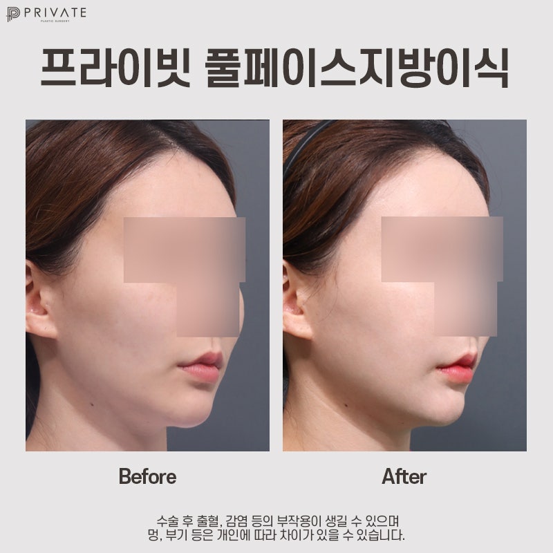 풀페이스지방이식후기 좋은 프라이빗성형외과 사진 10