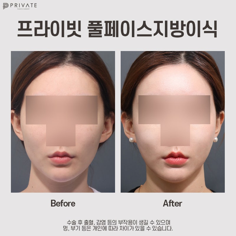 풀페이스지방이식후기 좋은 프라이빗성형외과 사진 9
