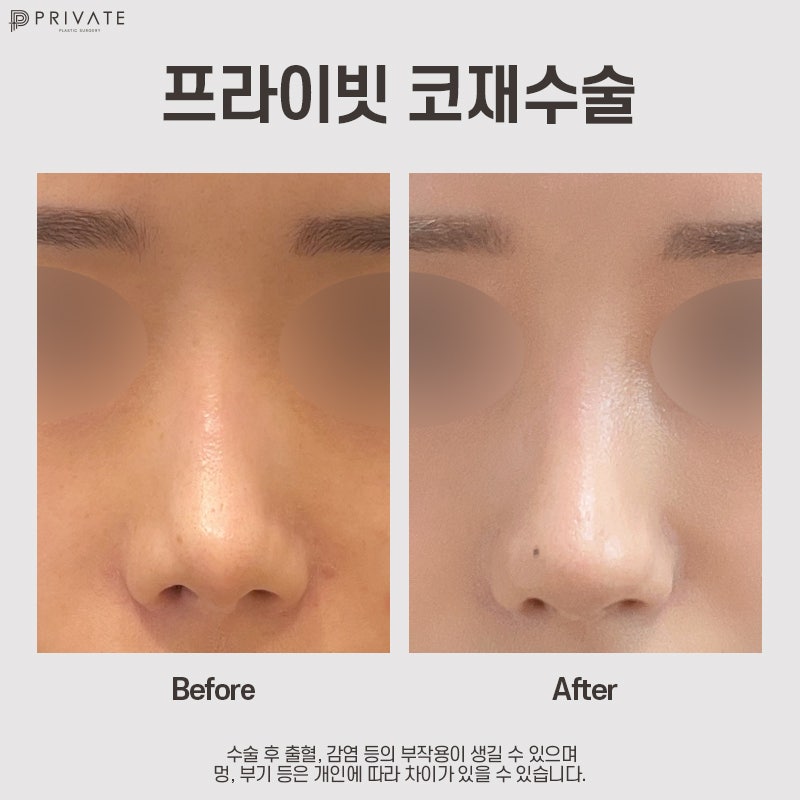 코재수술성형외과 알아보고 있다면? 프라이빗성형외과 사진 11