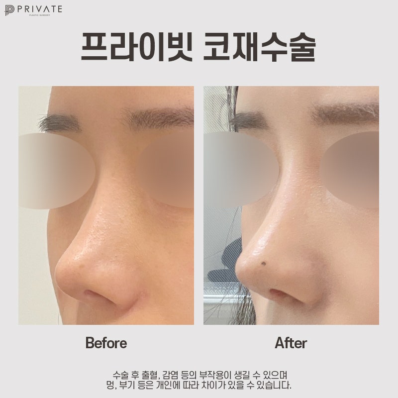 코재수술성형외과 알아보고 있다면? 프라이빗성형외과 사진 10