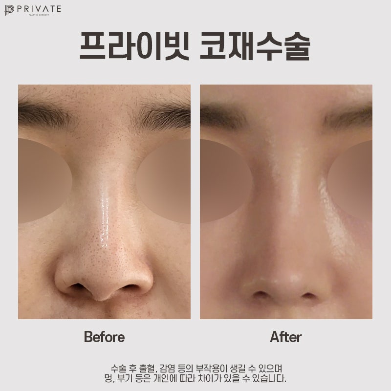 코재수술성형외과 알아보고 있다면? 프라이빗성형외과 사진 9
