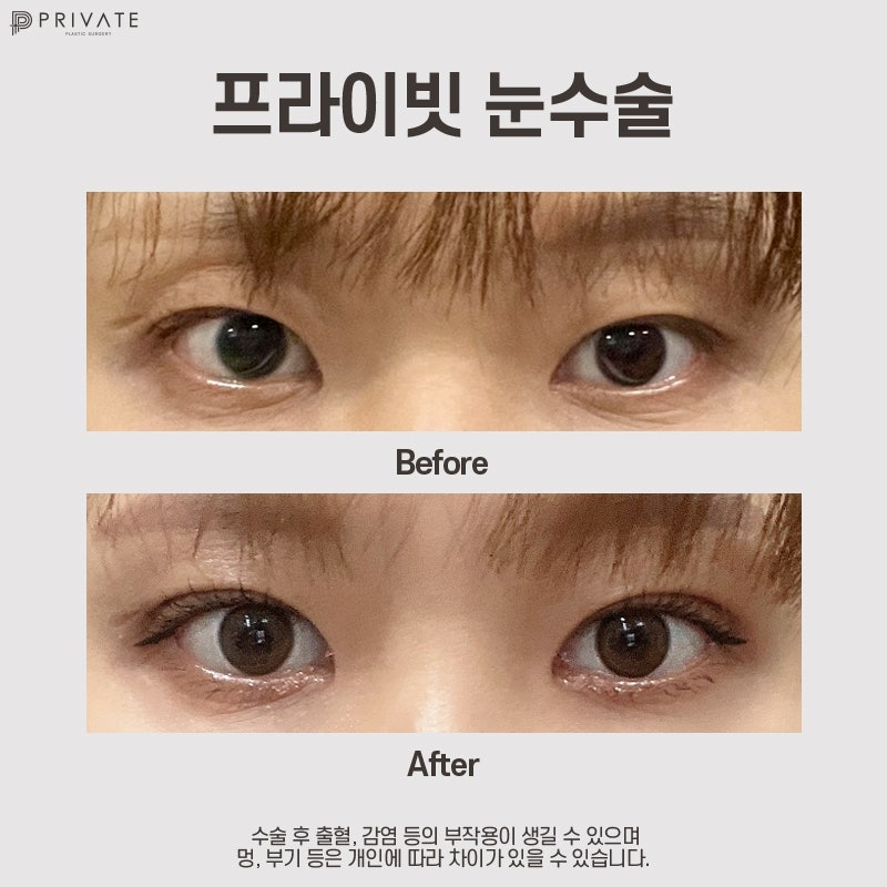 비절개눈매교정수술 잘하는곳 프라이빗성형외과 사진 9