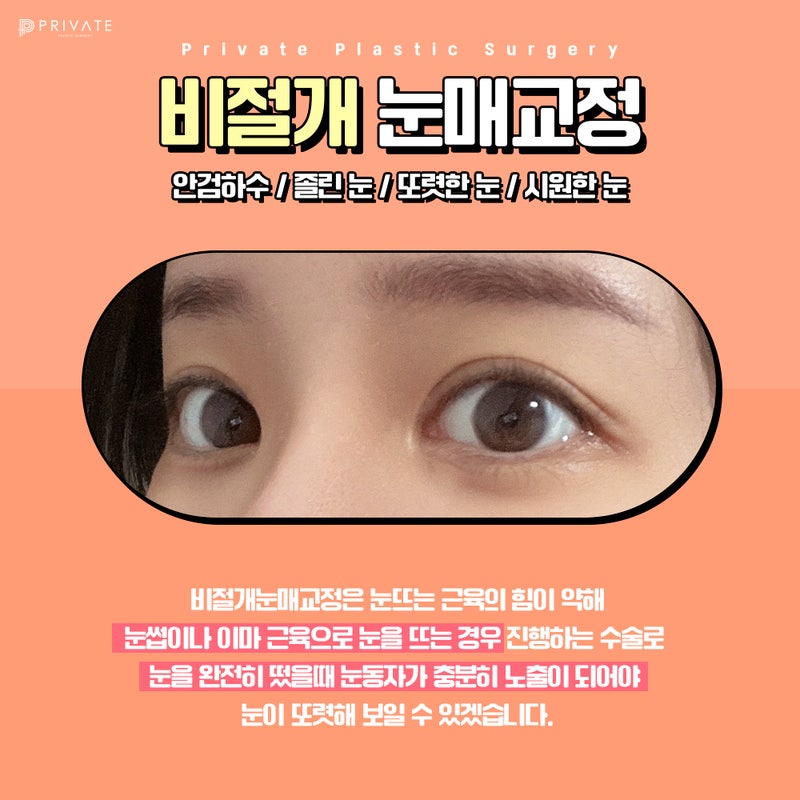 비절개눈매교정수술 잘하는곳 프라이빗성형외과 사진 3