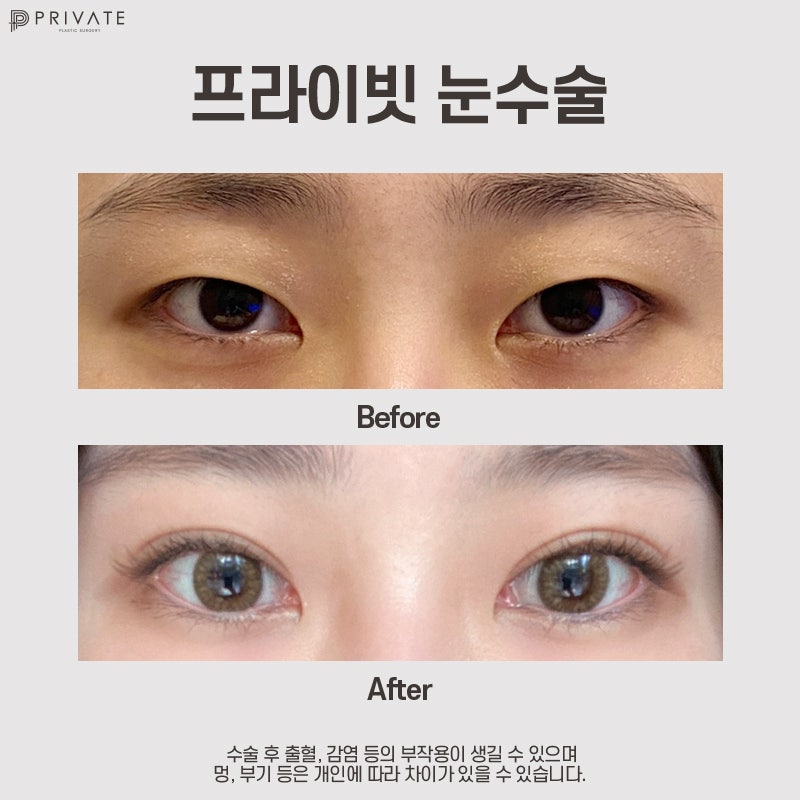 비절개눈매교정수술 잘하는곳 프라이빗성형외과 사진 10