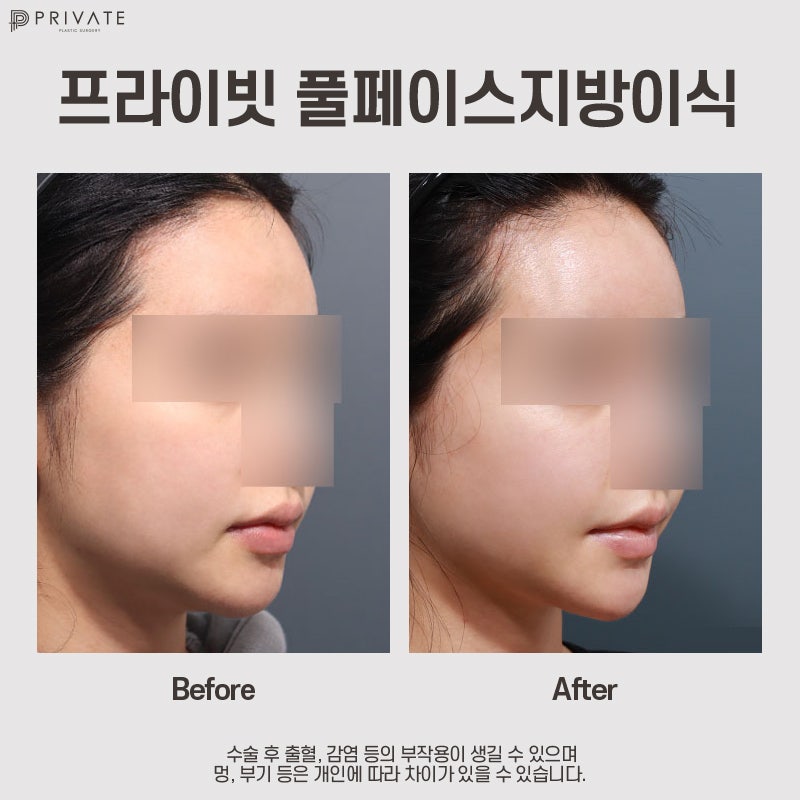 Tempat Terbaik untuk Transplantasi Lemak Wajah adalah Private Plastic Surgery di Stasiun Sinsa 사진 11