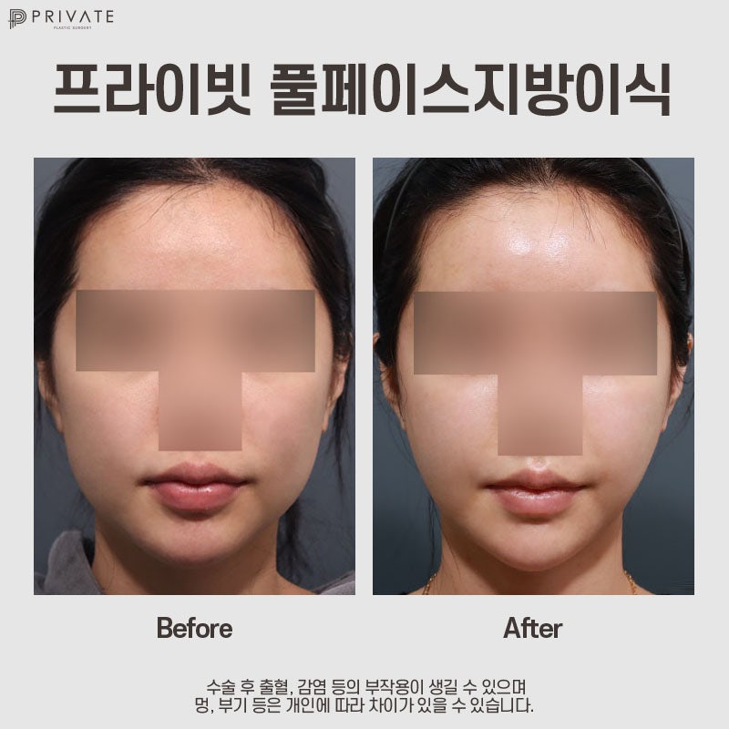 Tempat Terbaik untuk Transplantasi Lemak Wajah adalah Private Plastic Surgery di Stasiun Sinsa 사진 10