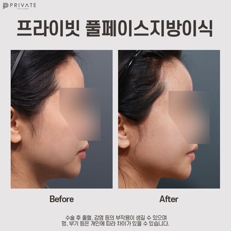 Tempat Terbaik untuk Transplantasi Lemak Wajah adalah Private Plastic Surgery di Stasiun Sinsa 사진 12