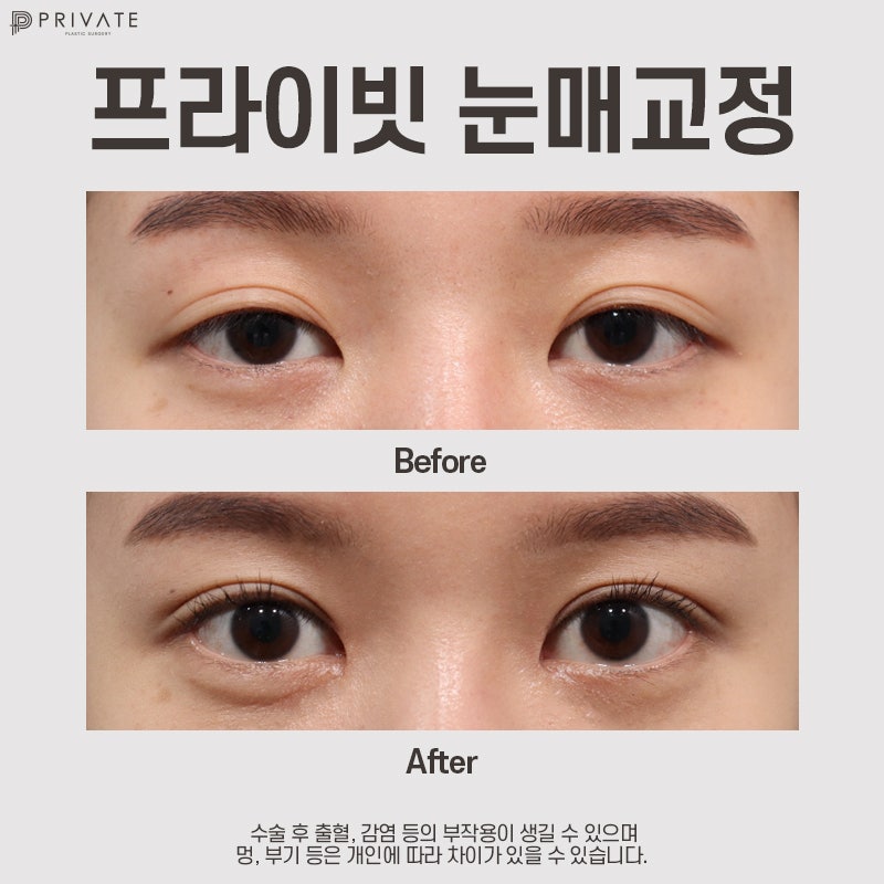 눈매교정수술전후 보정없는 프라이빗성형외과 사진 9
