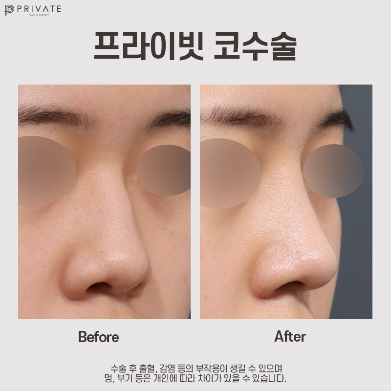 Private Plastic Surgery Clinic, Recommended for Nose Surgery 사진 11