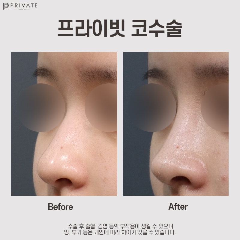 Private Plastic Surgery Clinic, Recommended for Nose Surgery 사진 9