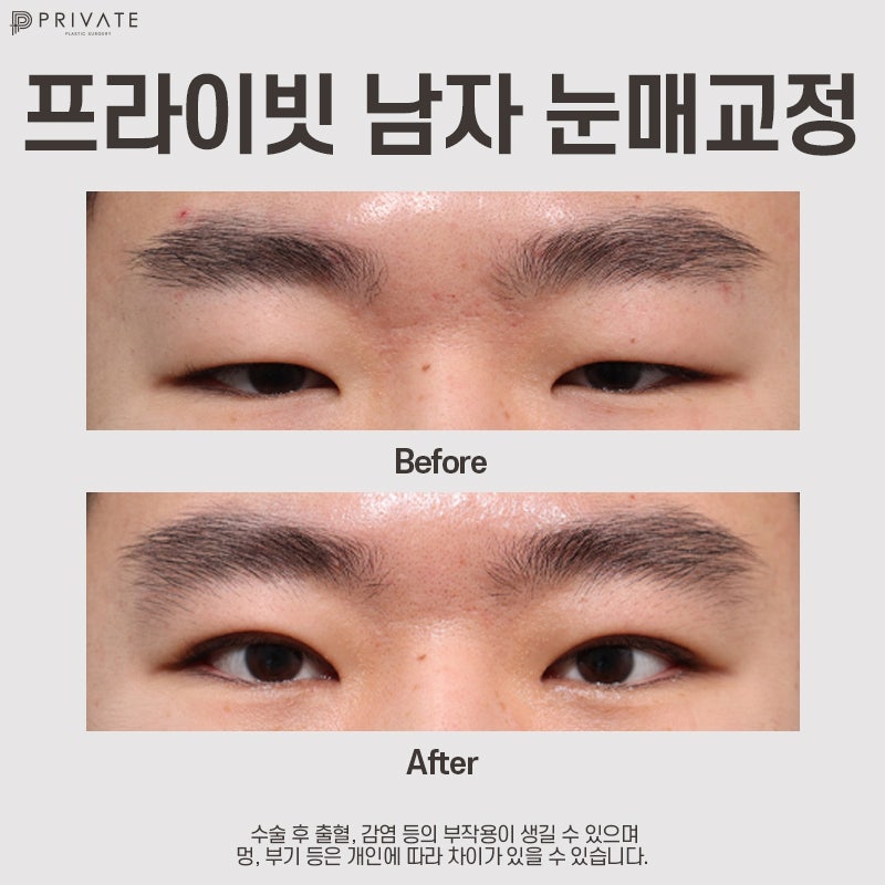 Perbandingan Sebelum dan Sesudah Koreksi Mata Pria di Private Plastic Surgery 사진 5