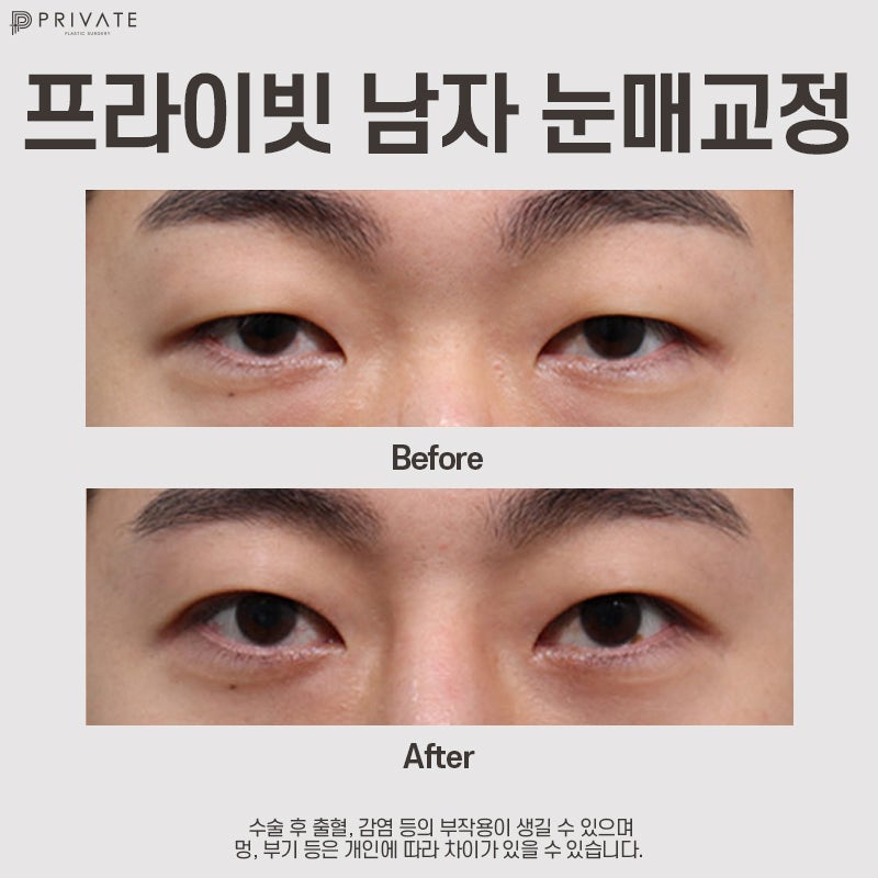 Perbandingan Sebelum dan Sesudah Koreksi Mata Pria di Private Plastic Surgery 사진 4