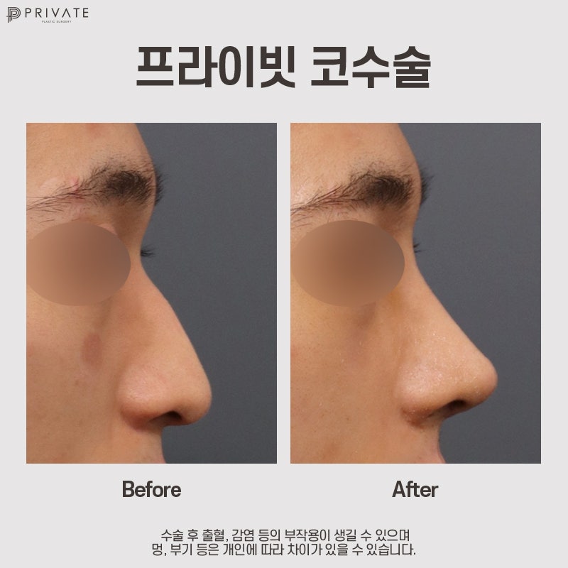 남자코성형전후가 궁금하다면? 프라이빗성형외과 사진 8