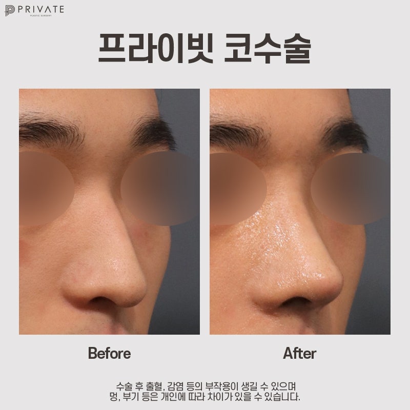 남자코성형전후가 궁금하다면? 프라이빗성형외과 사진 9