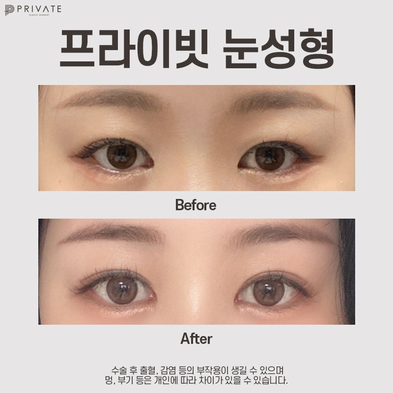쌍수 절개 후기가 좋은 프라이빗성형외과 사진 9