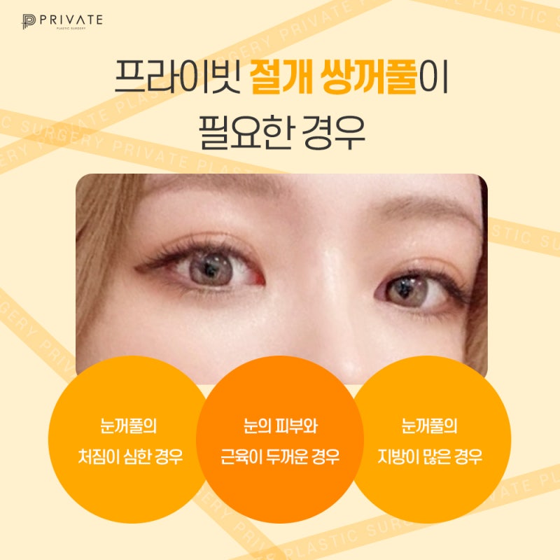 쌍수 절개 후기가 좋은 프라이빗성형외과 사진 5