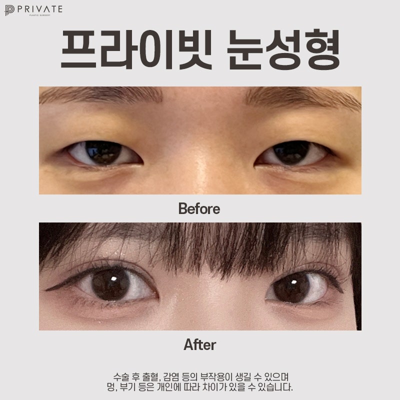 쌍수 절개 후기가 좋은 프라이빗성형외과 사진 8