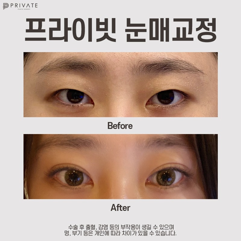 눈매교정쌍수잘하는곳 프라이빗성형외과 사진 10