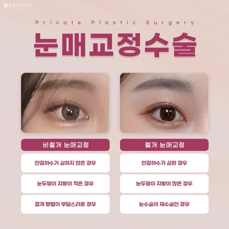 눈매교정쌍수잘하는곳 프라이빗성형외과 사진 6