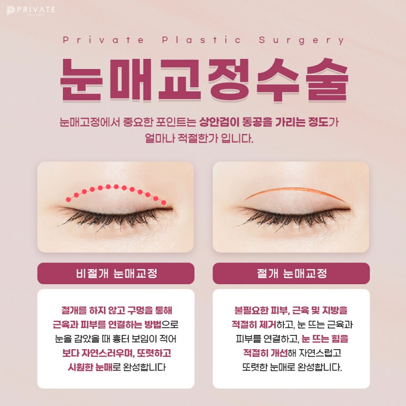 눈매교정쌍수잘하는곳 프라이빗성형외과 사진 5
